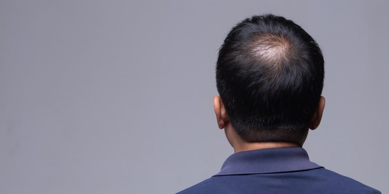 Kenali Pemicu Kerontokan Rambut Sejak Dini