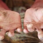 Kusta Di Papua Barat Butuh Penanganan Serius