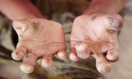 Kusta Di Papua Barat Butuh Penanganan Serius